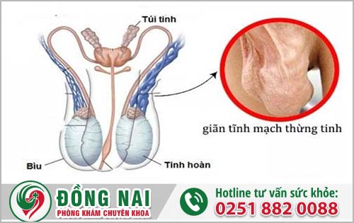 Nguyên Nhân Gây Giãn Thừng Mạch Tinh Ở Nam Giới